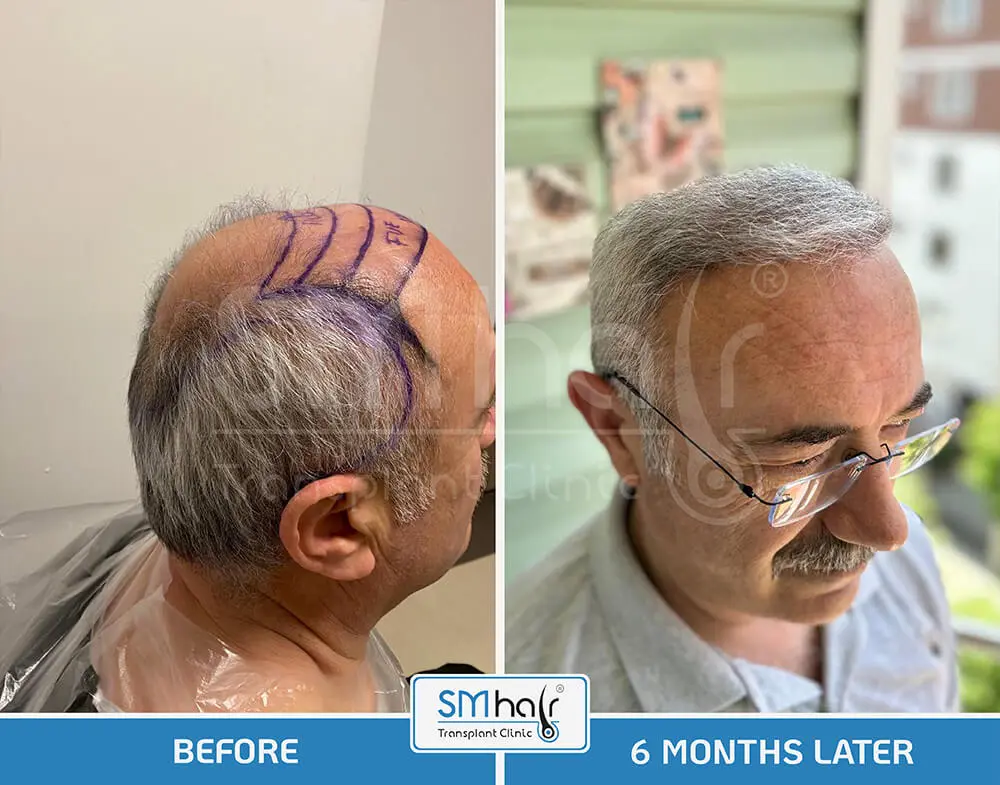 SM Hair Clinic Before-After 41