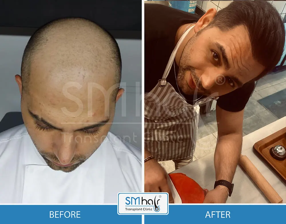 SM Hair Clinic Before-After 32