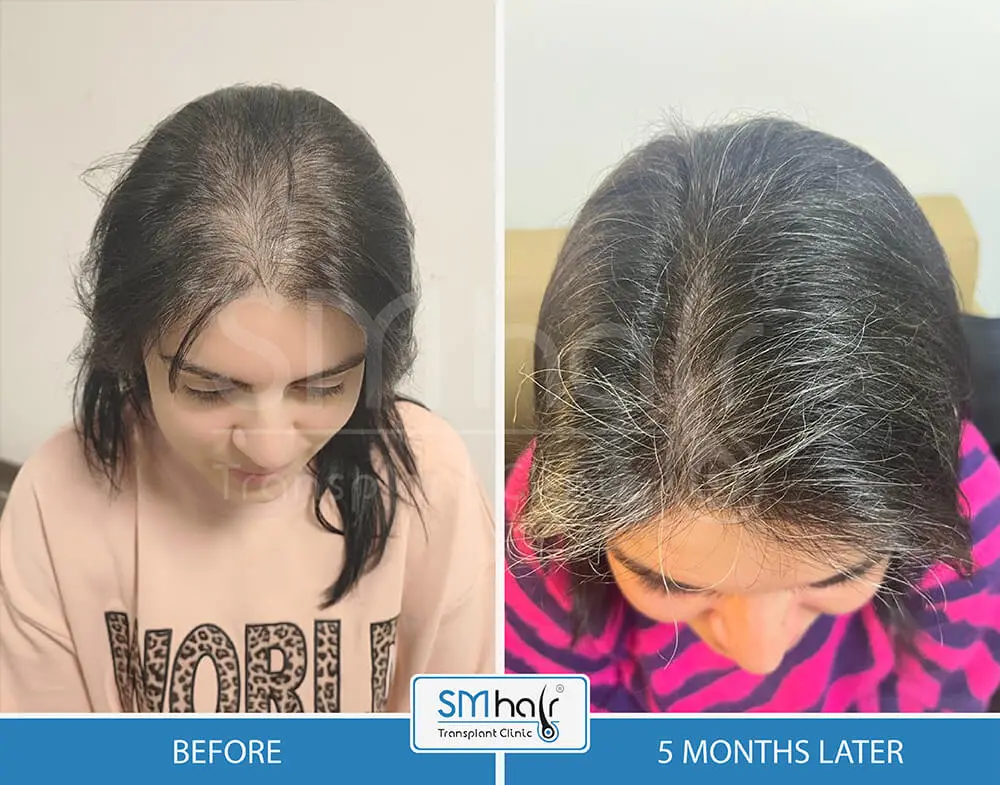 SM Hair Clinic Before-After 36