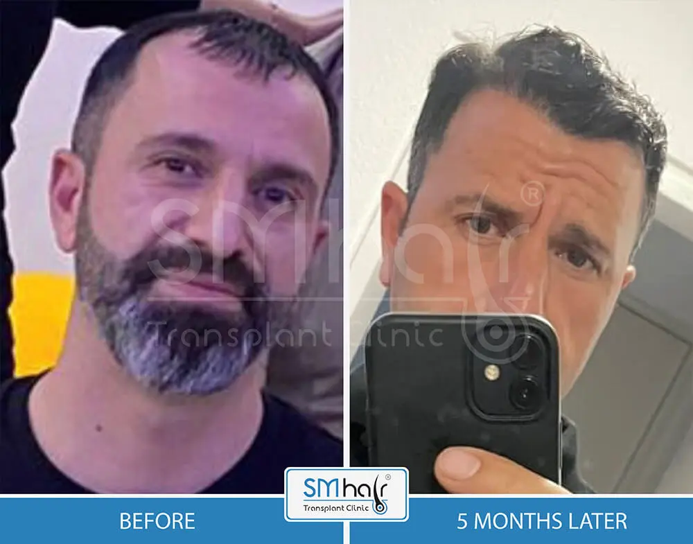 SM Hair Clinic Before-After 34