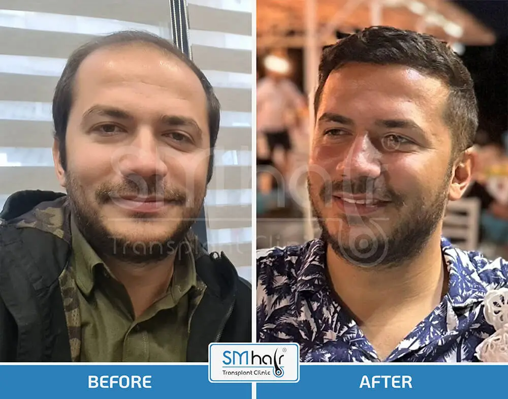 SM Hair Clinic Before-After 48