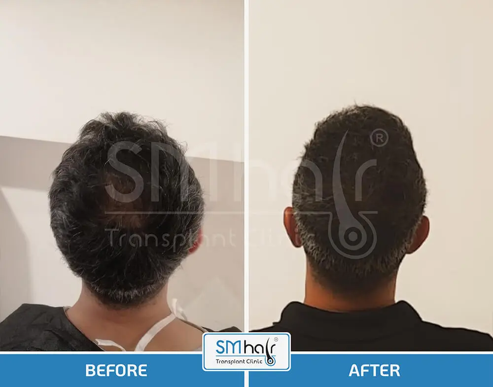 SM Hair Clinic Before-After 25