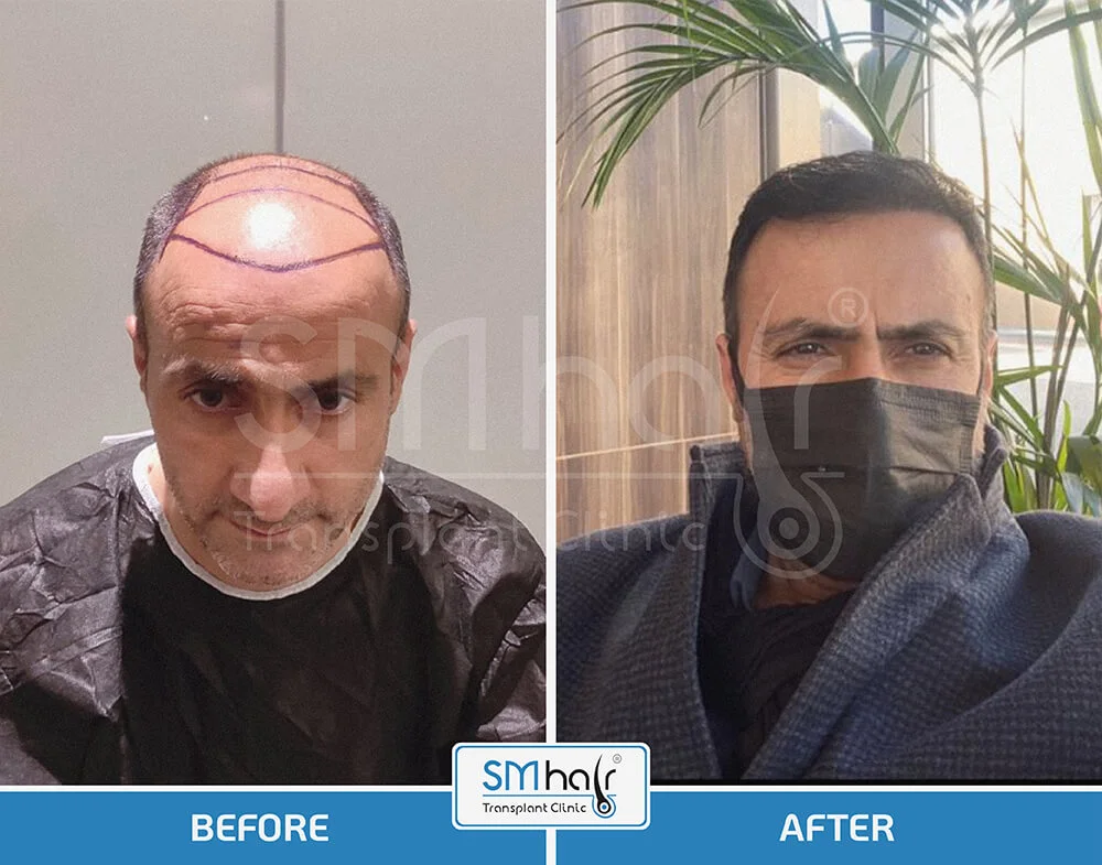 SM Hair Clinic Before-After 27