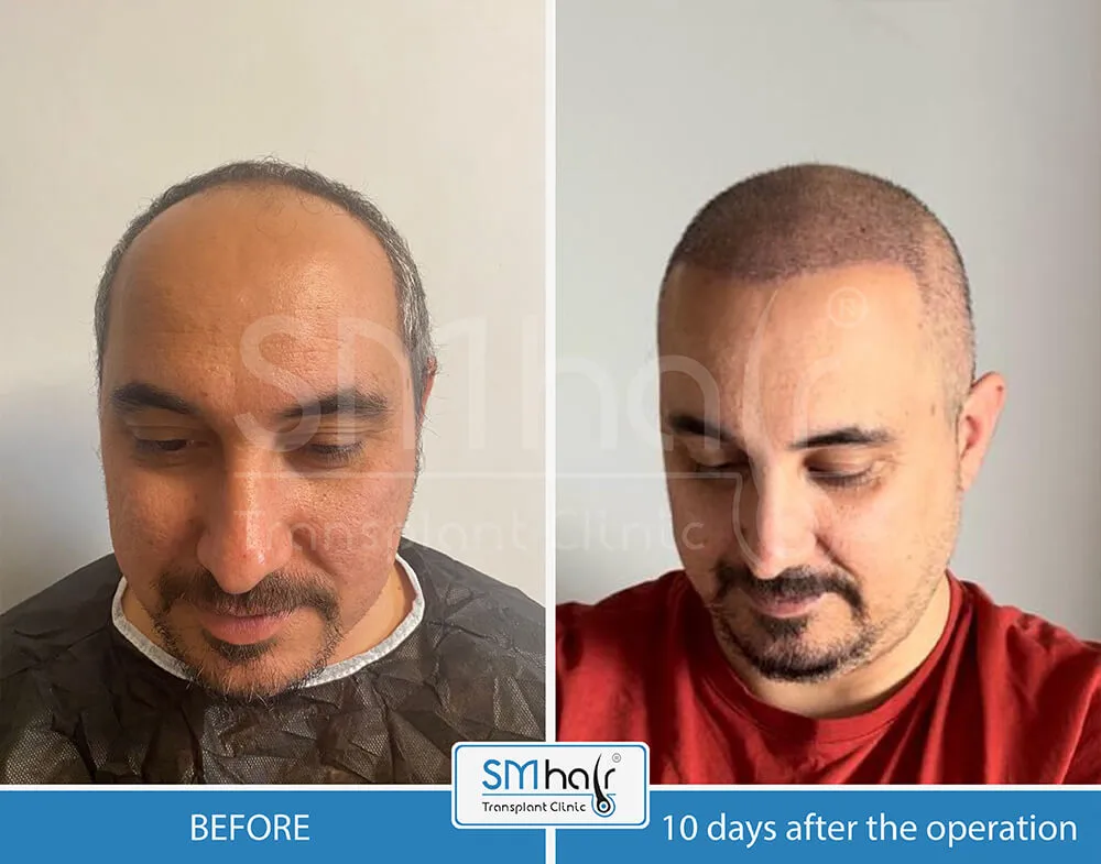 SM Hair Clinic Before-After 39