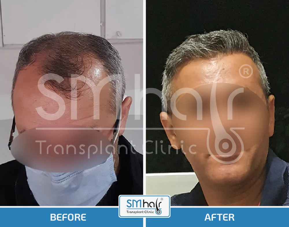 SM Hair Clinic Before-After 7