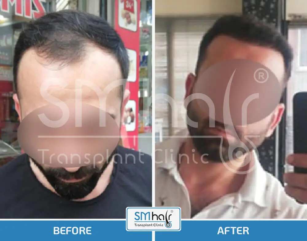 SM Hair Clinic Before-After 6