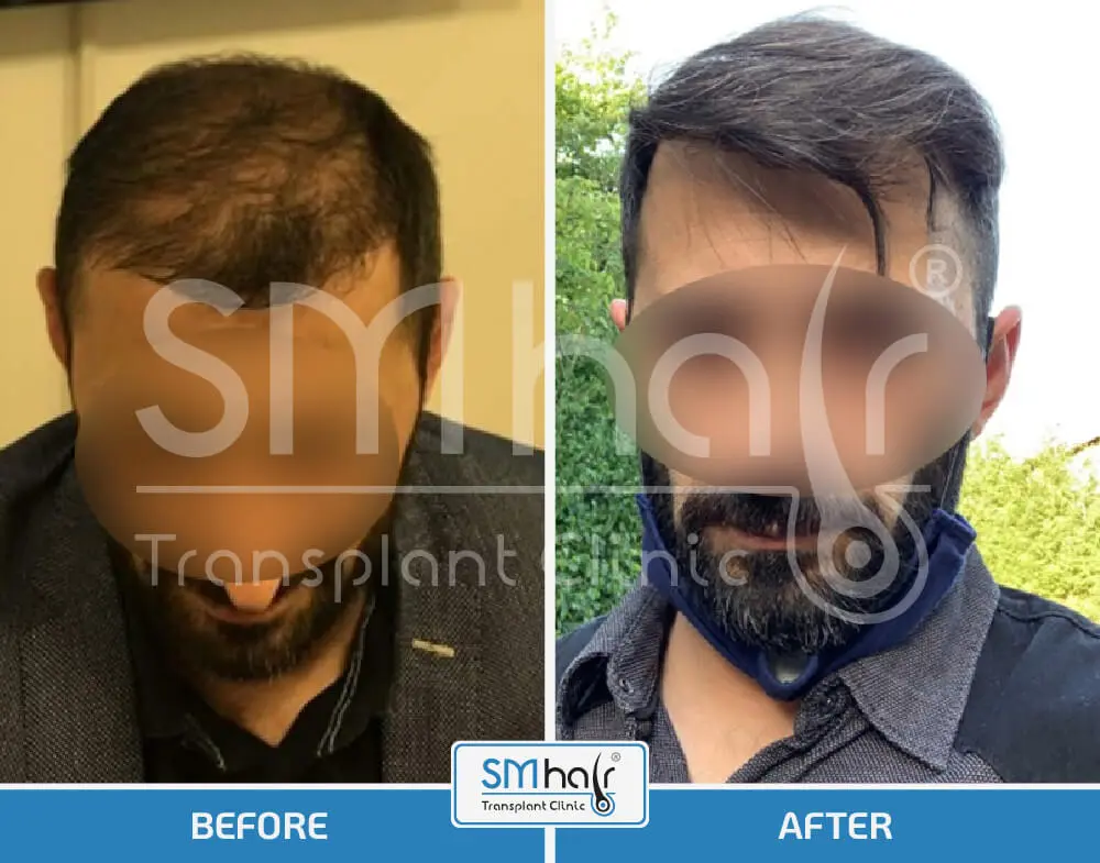 SM Hair Clinic Before-After 4