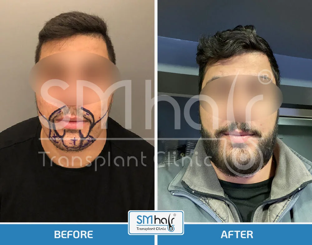 SM Hair Clinic Before-After 3