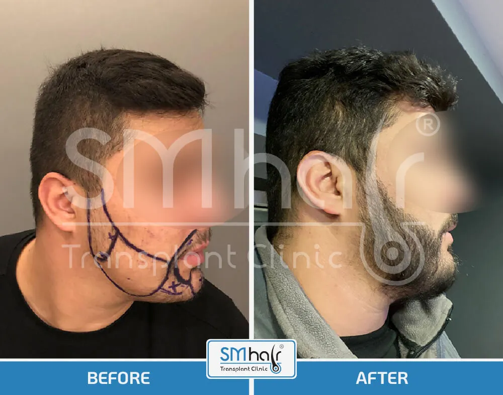 SM Hair Clinic Before-After 2