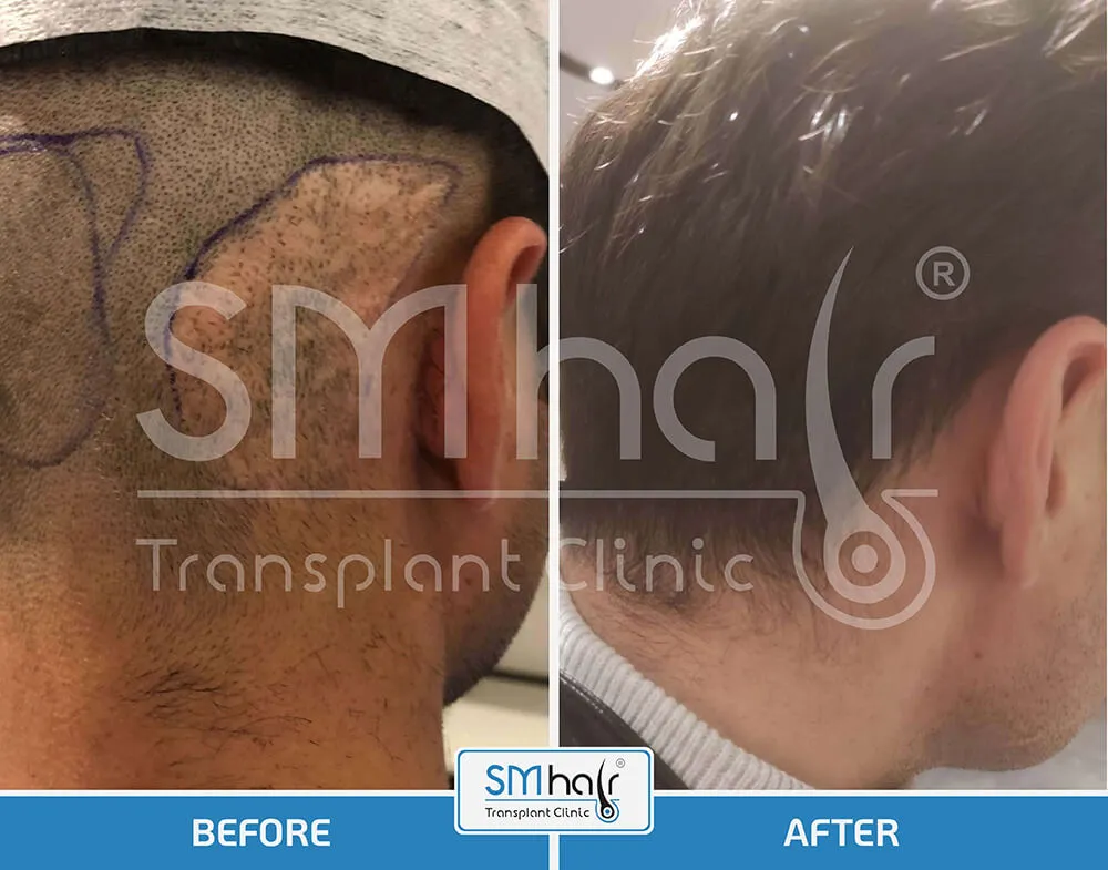 SM Hair Clinic Before-After 18