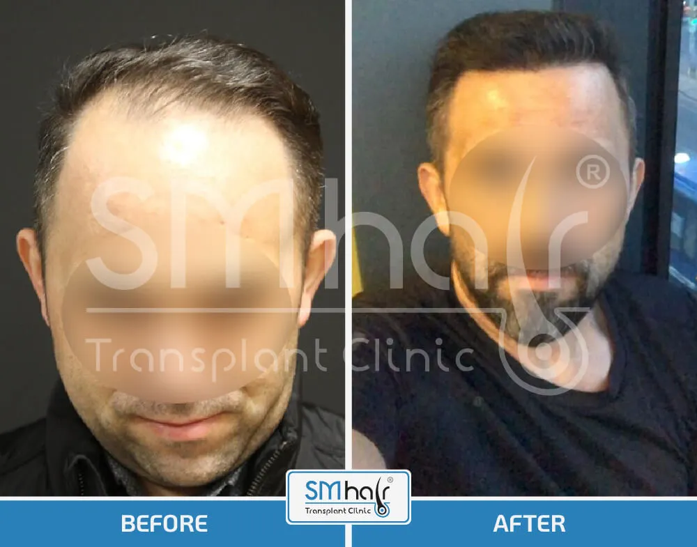 SM Hair Clinic Before-After 16