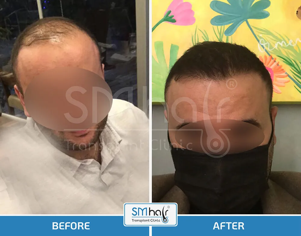 SM Hair Clinic Before-After 20