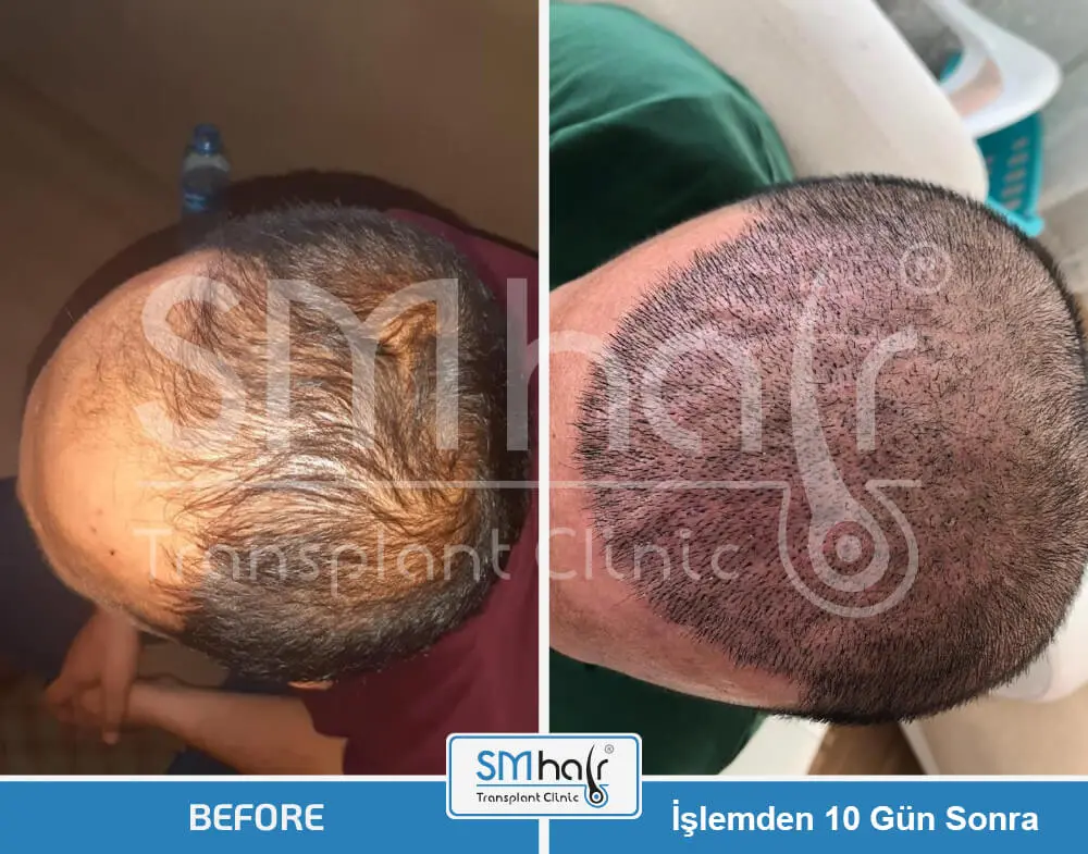 SM Hair Clinic Before-After 9
