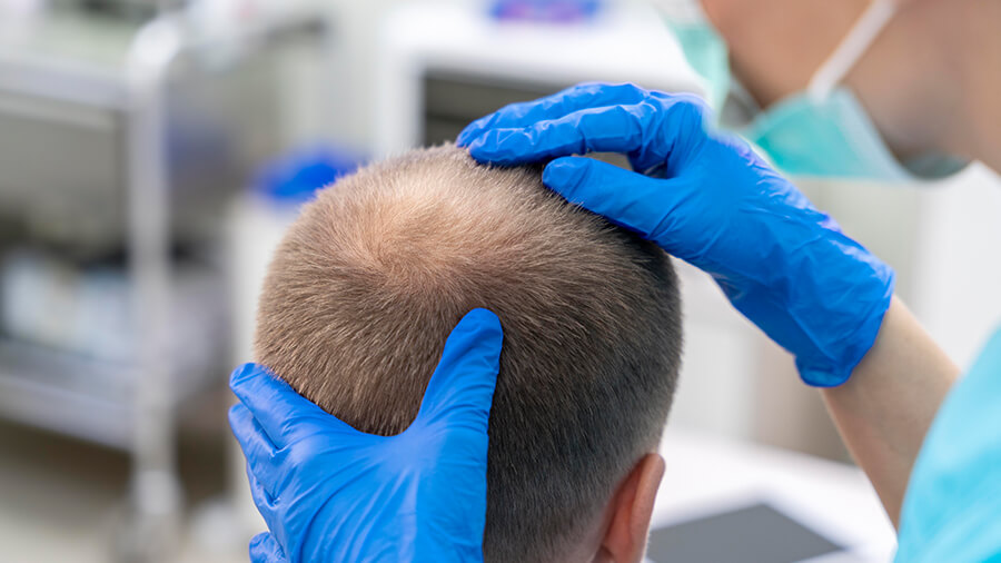 Dinge, die vor und nach der Haartransplantation zu beachten sind