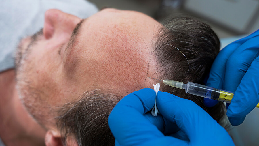 Wie wird die PRP-Anwendung bei der Haartransplantation durchgeführt?