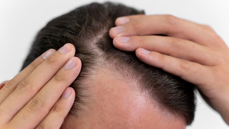 Wie wird eine unrasierte und schmerzfreie Haartransplantation durchgeführt?