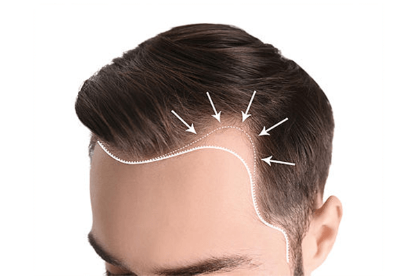 Unrasierte Haartransplantation